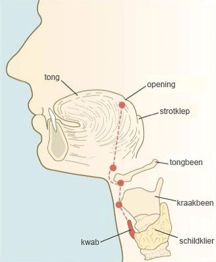 Aanlegstoornis