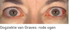 Oogziekte Graves rodeogen 1