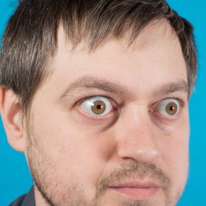 a man with bulging eyes with graves disease on blueF vierkant 300x300 1