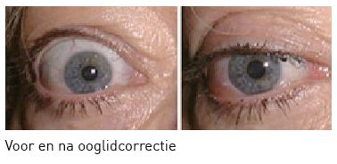 ooglidcorrectie voor en na