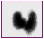 scintigram Graves